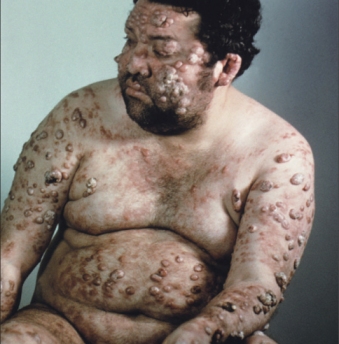 leishmaniosis2